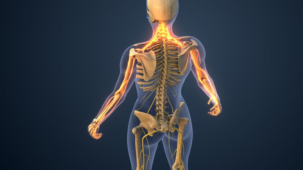 Cervical,Radiculopathy,Or,Brachialgia,Medical,3d,Illustration