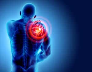 X-ray image highlighting nerve damage, illustrating neurological injury and medical diagnostic evaluation